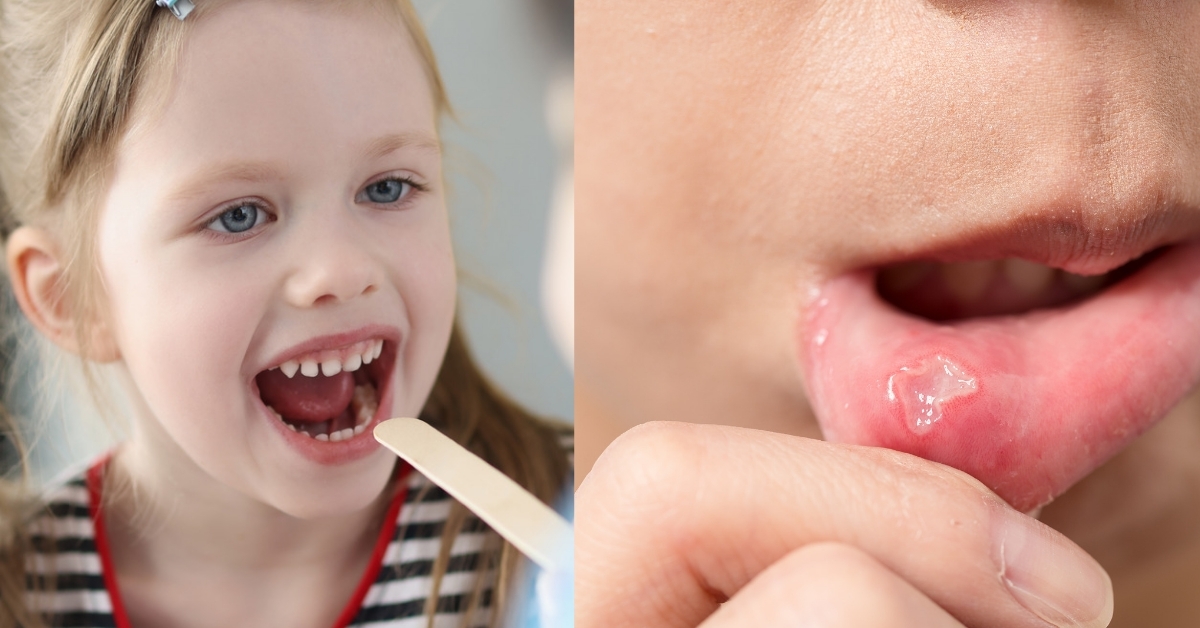 Cold Sores vs Canker Sores What's the difference between