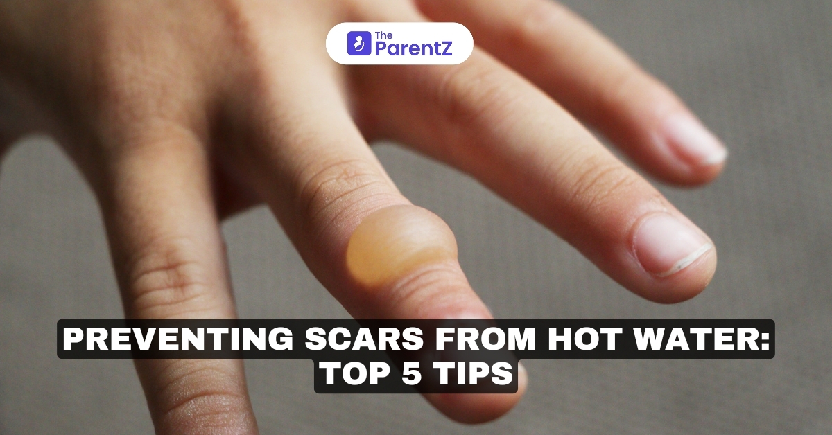 Preventing Scars From Hot Water: Top 5 Tips