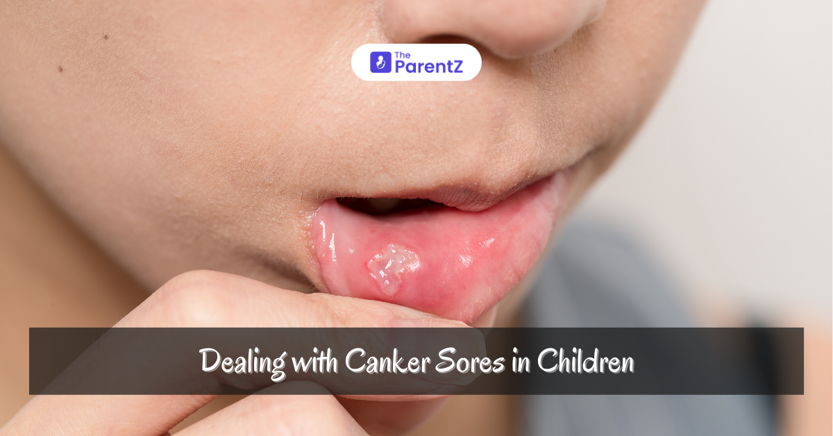 Canker Sores in Children: Causes, Symptoms, and Effective Treatment Options