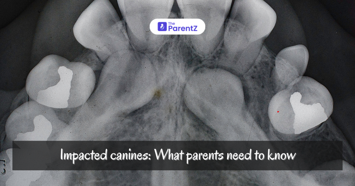 Impacted Canines: What Parents Need to Know for Early Detection and Treatment