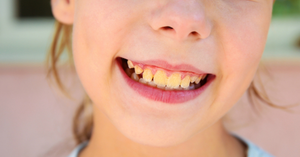 Preventing Plaque Buildup in Children