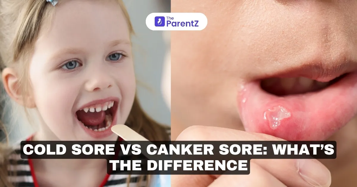 Cold Sores vs Canker Sores: What's the difference