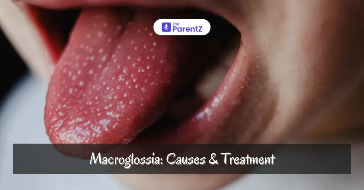 Macroglossia: Causes & Treatment