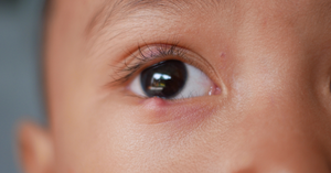 Bumps Under Eyelids: Here's What You Need To Know