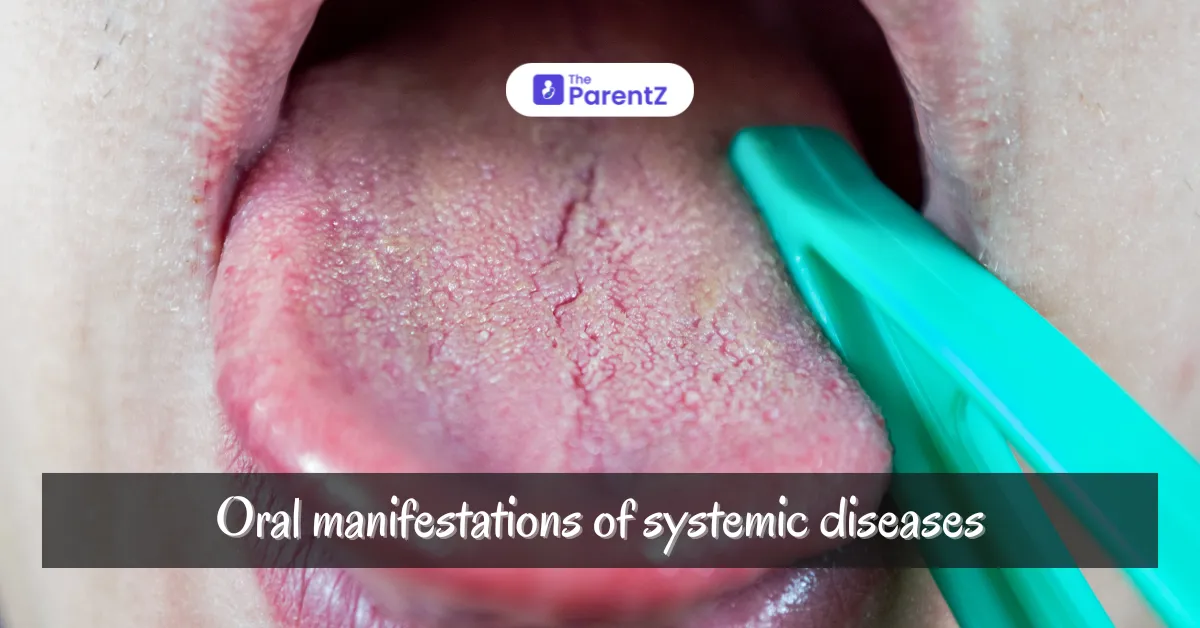 Oral manifestations of systemic diseases