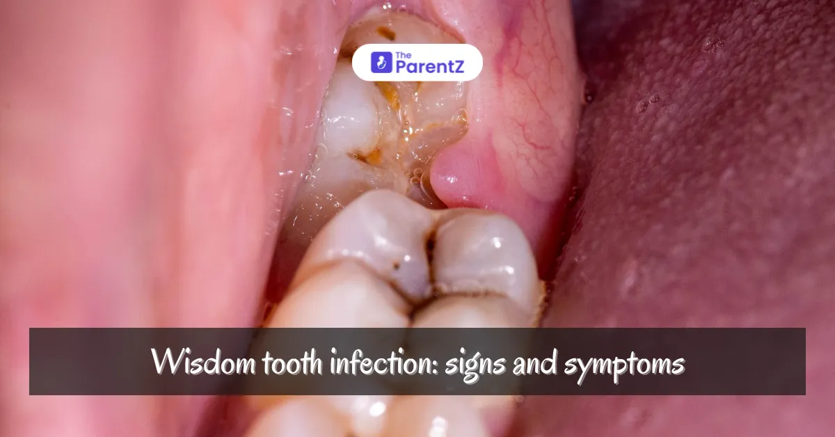 Wisdom Tooth Infection in Children: Signs and Symptoms