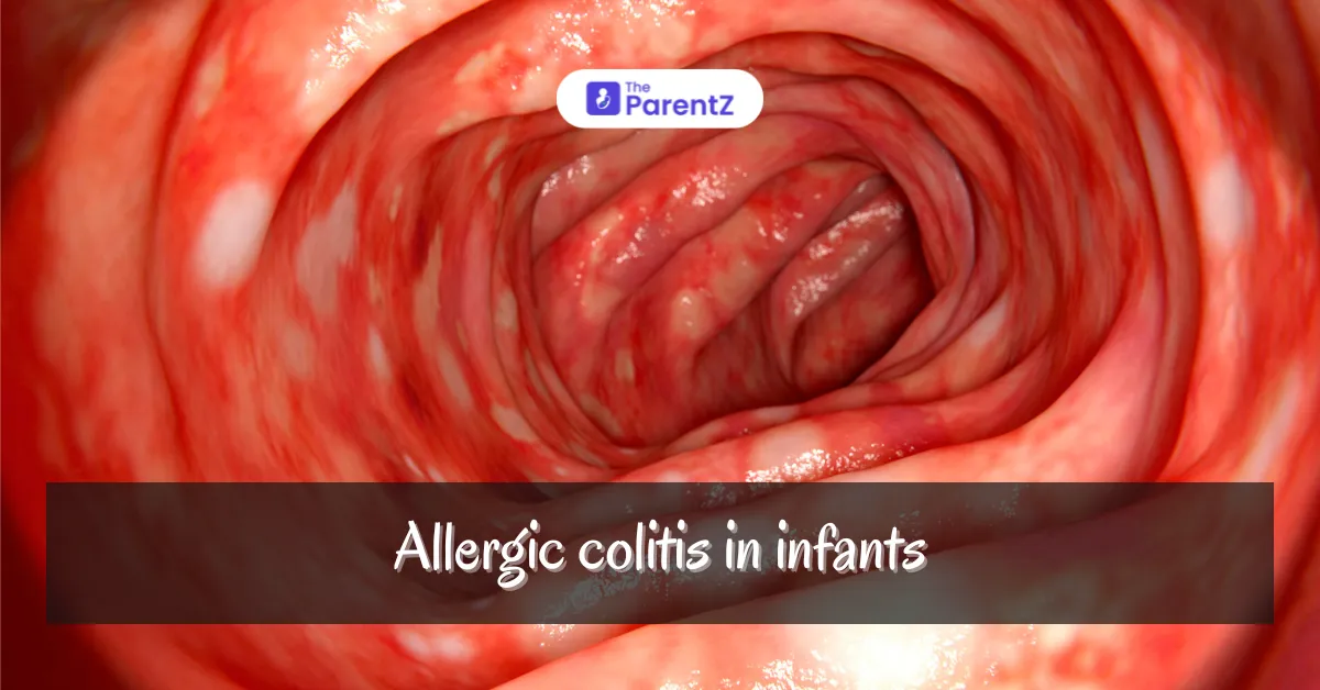 Allergic Colitis in Children: Causes, Symptoms, and Management