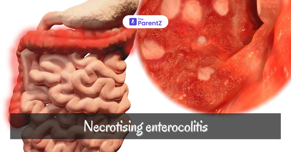 Necrotizing Colitis in Children: Causes, Symptoms, and Management