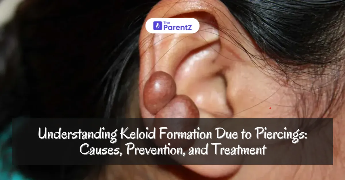 Understanding Keloid Formation Due to Piercings: Causes, Prevention, and Treatment