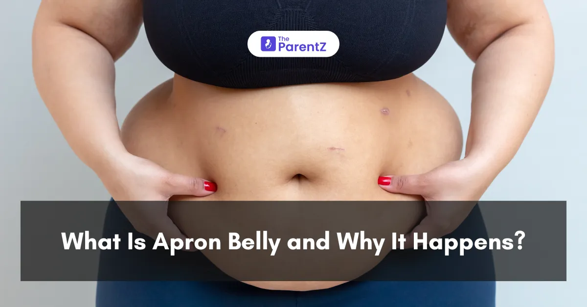 What Is Apron Belly and Why It Happens?