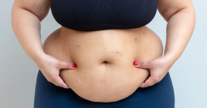 What Is Apron Belly and Why It Happens?
