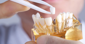Choosing the Right Dental Solution: A Parent’s Guide to Implants and Alternatives