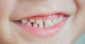 From Baby Teeth to Implants: Understanding the Stages of Oral Health
