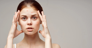 Acne, Hyperpigmentation, and the Overuse of Cosmetic Products in Teenagers