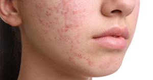 Common Causes and Treatment of Teenage Acne