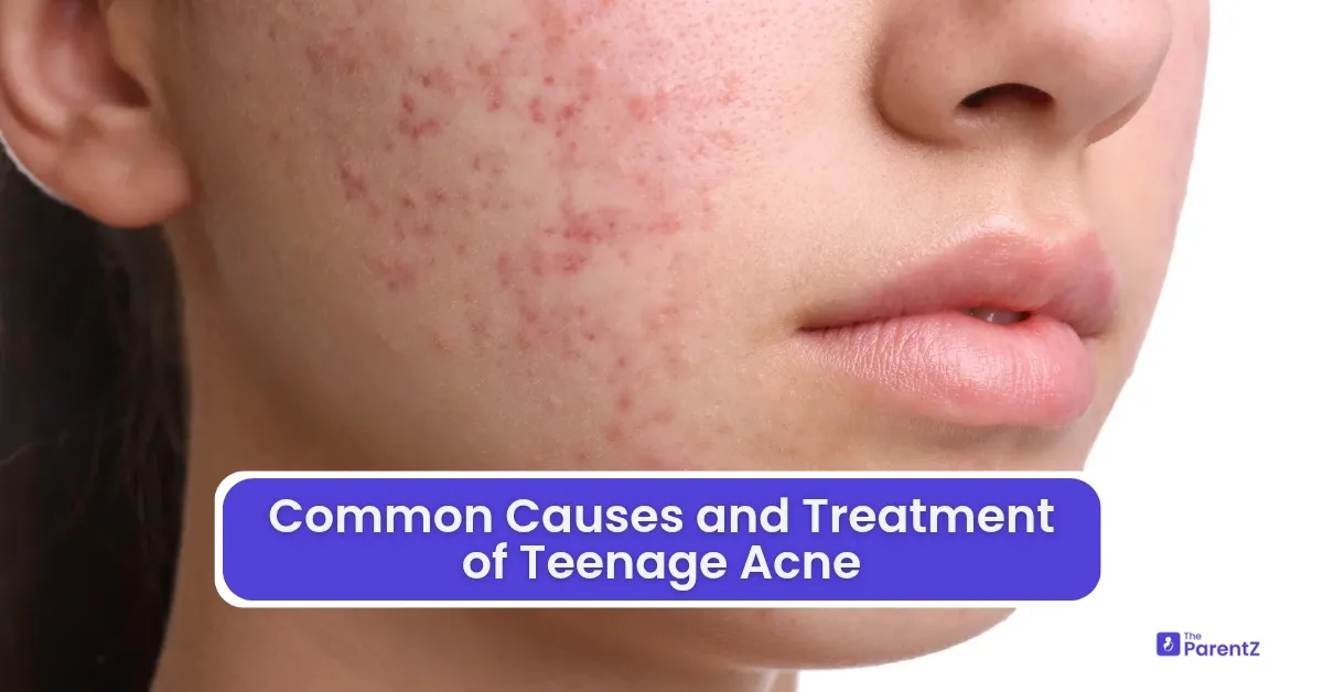 Common Causes and Treatment of Teenage Acne