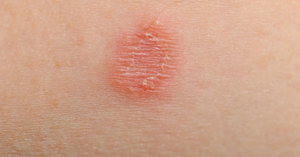 Common Parasitic Infections in Children: Worms and Skin Troubles