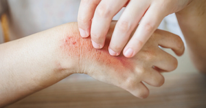 Preventing Heat Rash: Tips for Cool and Comfortable Kids