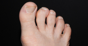 The Complexities of Charcot-Marie-Tooth Disease in Childhood: A Parent’s Guide