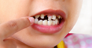 The Impact of Missing Teeth on Speech Development: Dental Implant Awareness