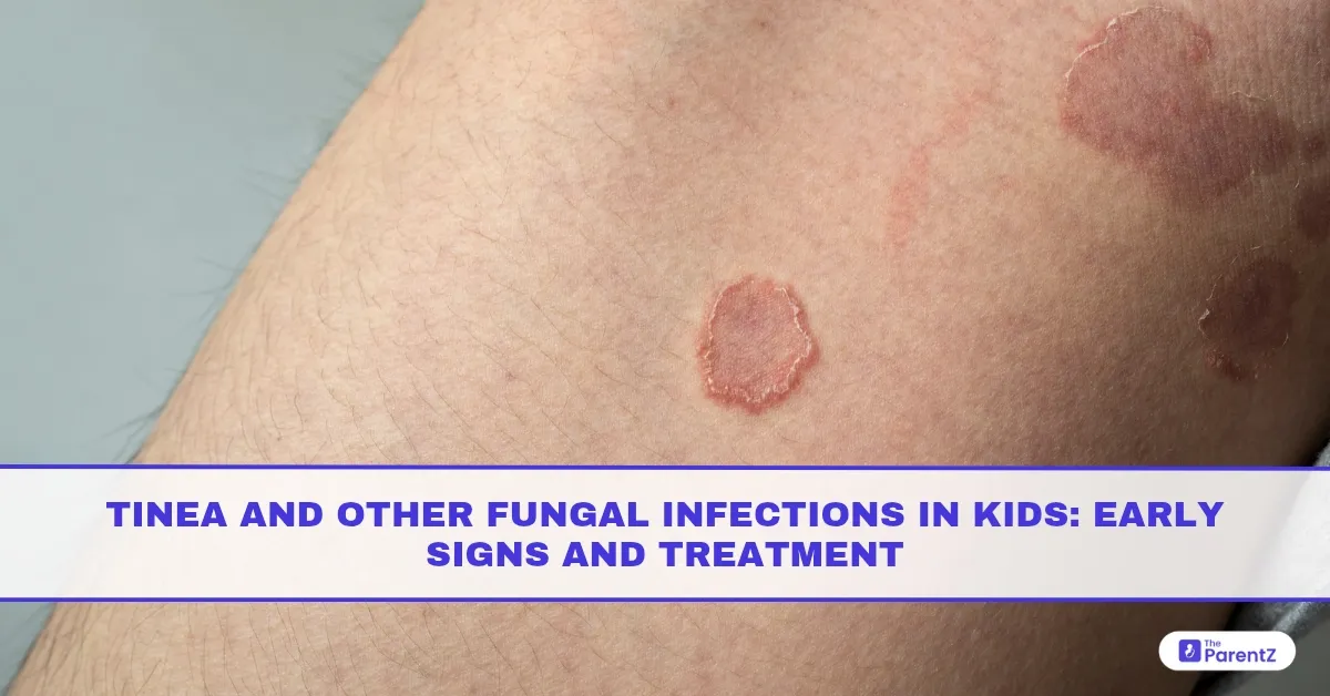 Tinea and Other Fungal Infections in Kids: Early Signs and Treatment