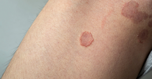 Tinea and Other Fungal Infections in Kids: Early Signs and Treatment