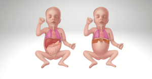 Understanding Congenital Diaphragmatic Hernia (CDH): A Guide for Parents and Caregivers