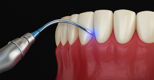 Bye-Bye Drill Fear! How Lasers Make Cavity Filling a Breeze for Kids