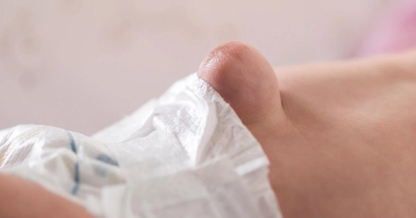 Congenital Diaphragmatic Hernia: Early Detection and Management in Newborns