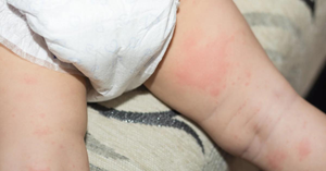 The Gentle Touch: How to Soothe and Prevent Diaper Rash Without Harsh Products