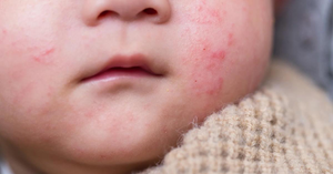 Why Is My Baby’s Skin So Sensitive? Understanding and Managing Common Newborn Rashes