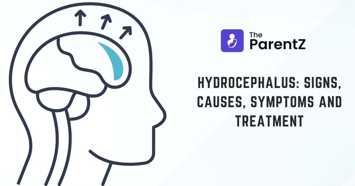 Hydrocephalus: Signs, Causes, Symptoms and Treatment