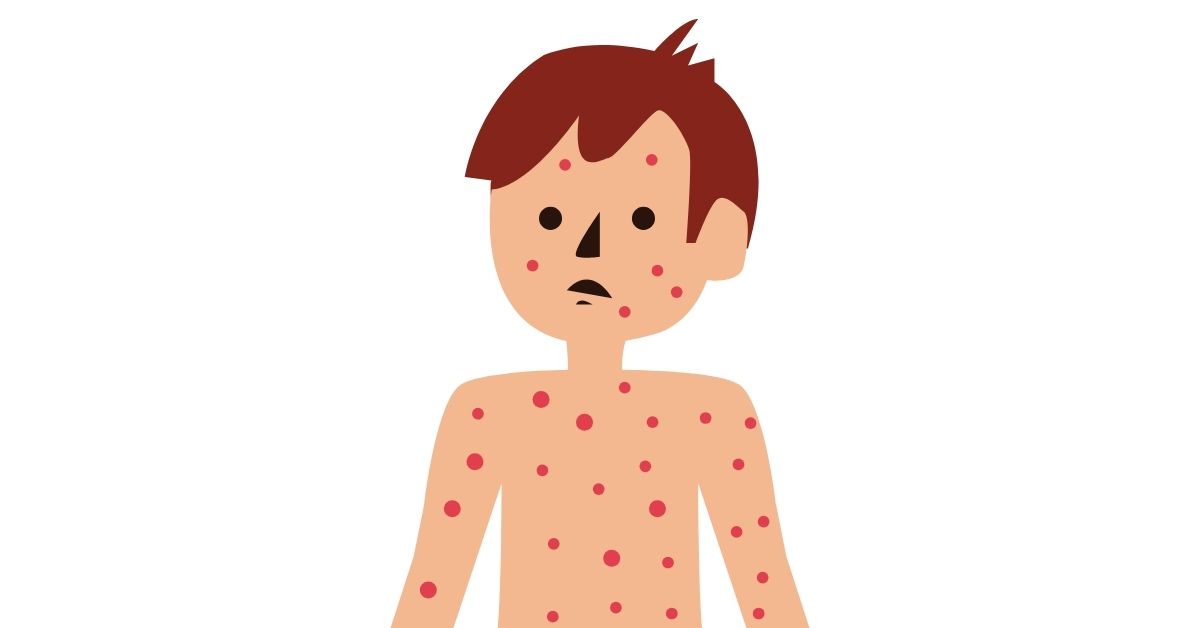 Measles Vaccine: Symptoms, Side Effects and Spread