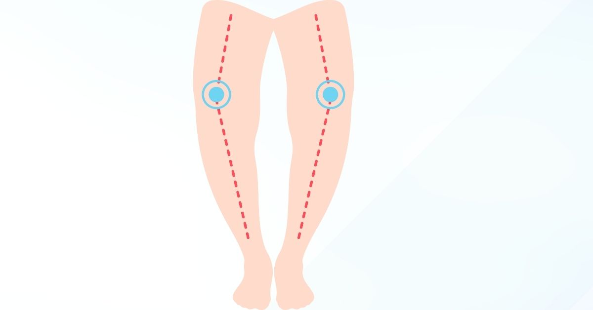 Rickets: Signs, Causes and Treatments