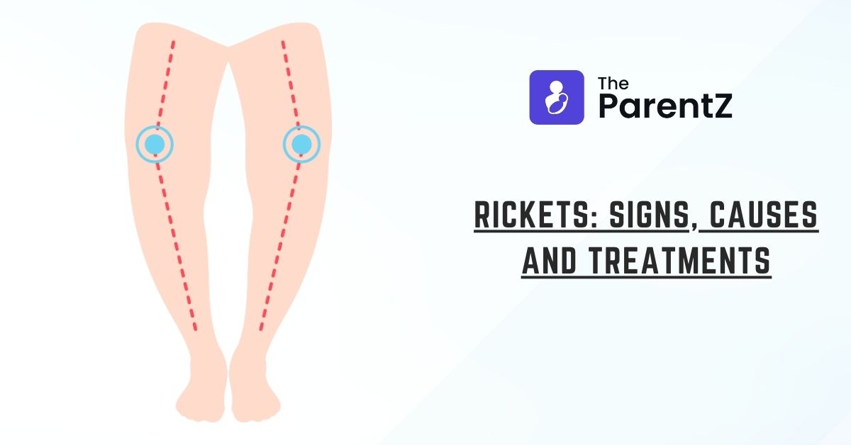 Rickets: Signs, Causes and Treatments