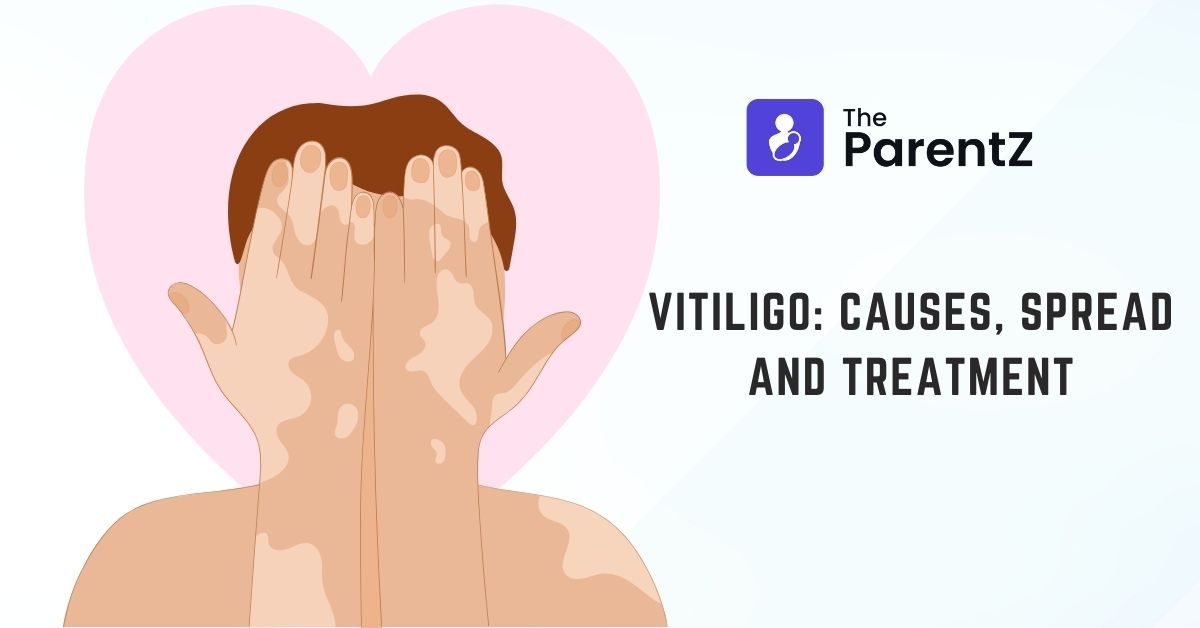 Vitiligo: Causes, Spread and Treatment