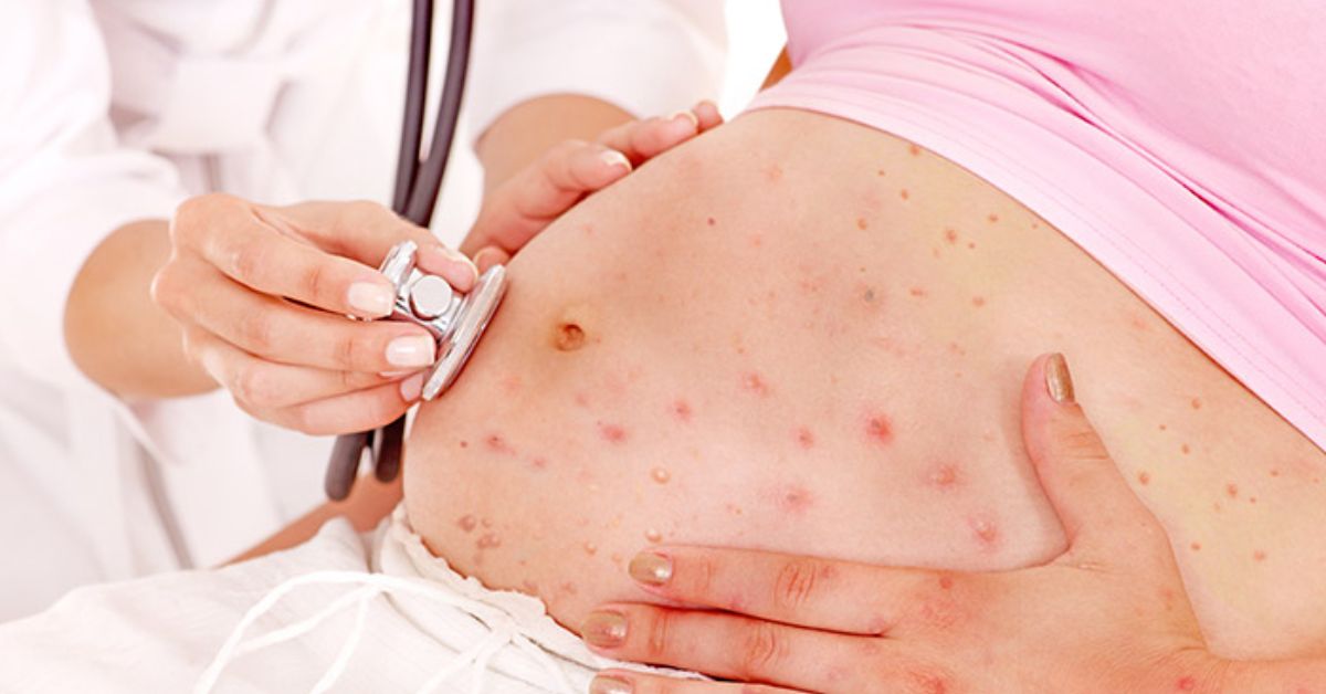 Chickenpox in pregnancy
