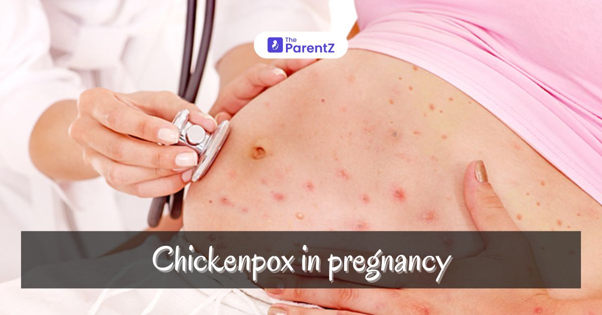 Chickenpox in pregnancy