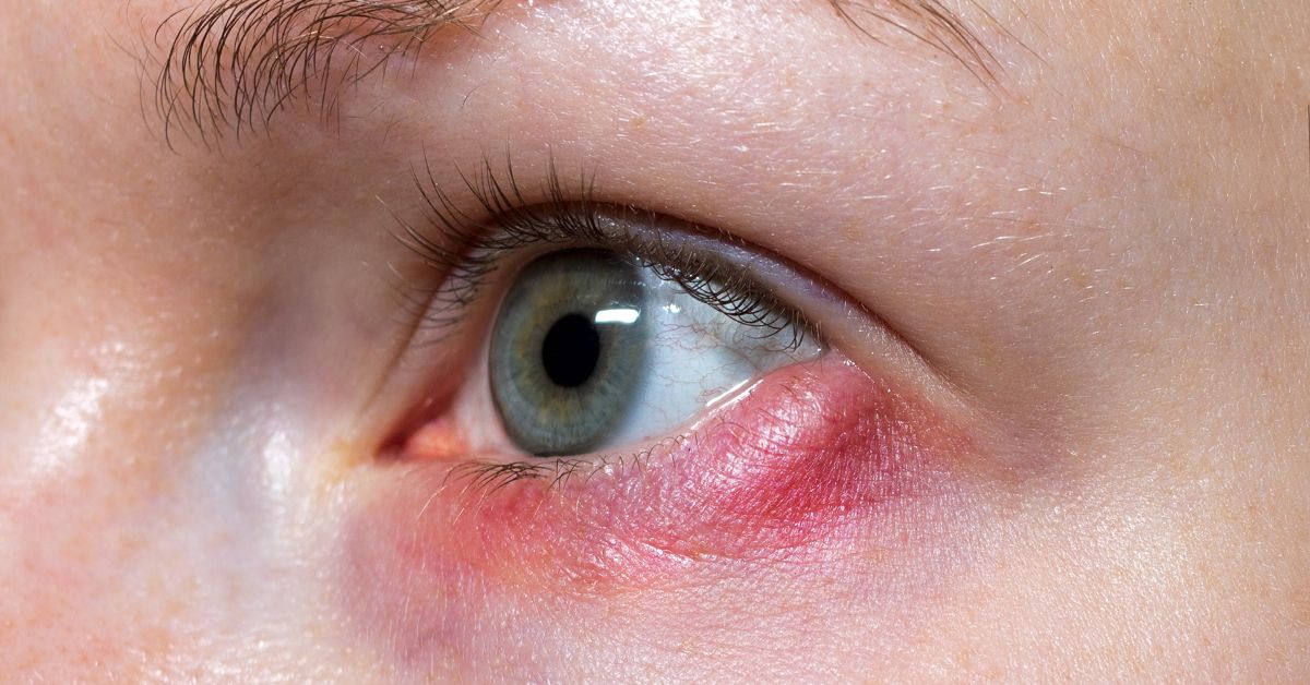 Hordeolum (Stye)