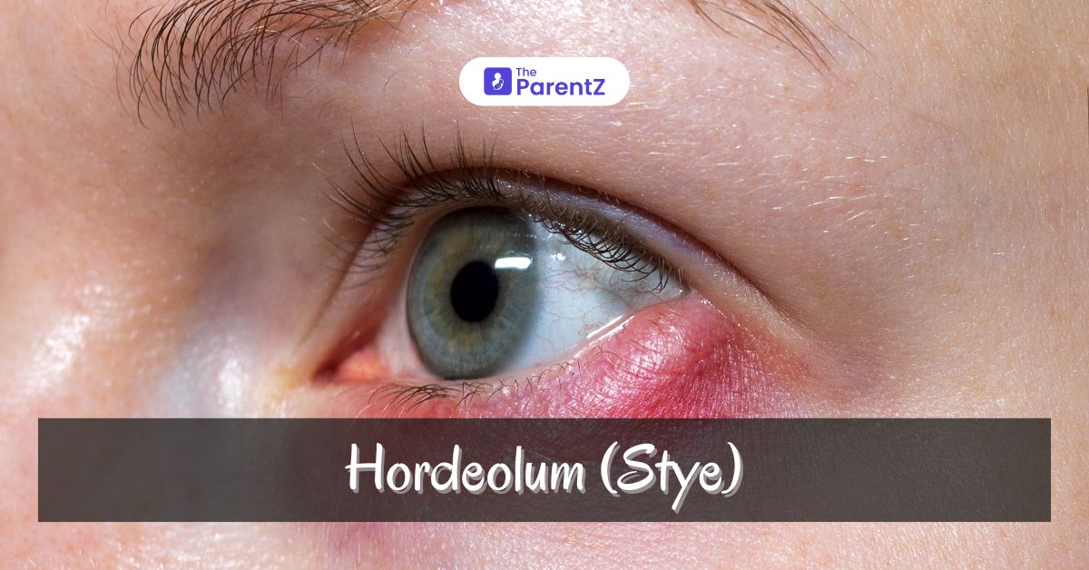 Hordeolum (Stye)