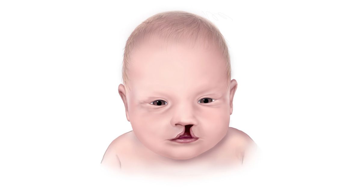 Patau syndrome
