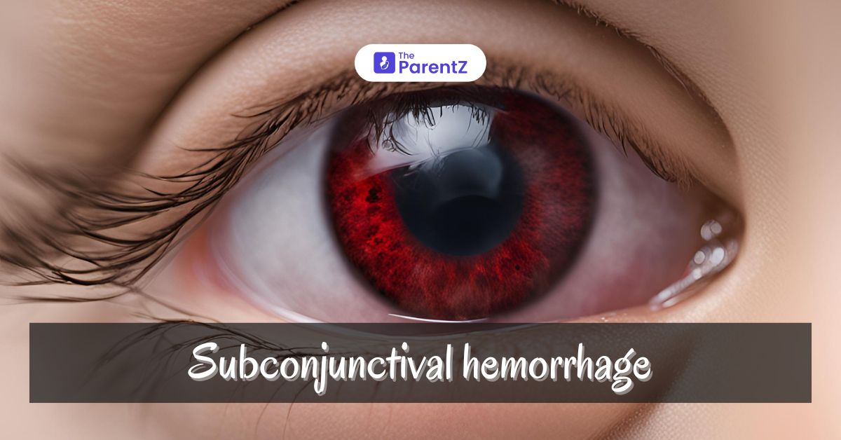 Subconjunctival hemorrhage