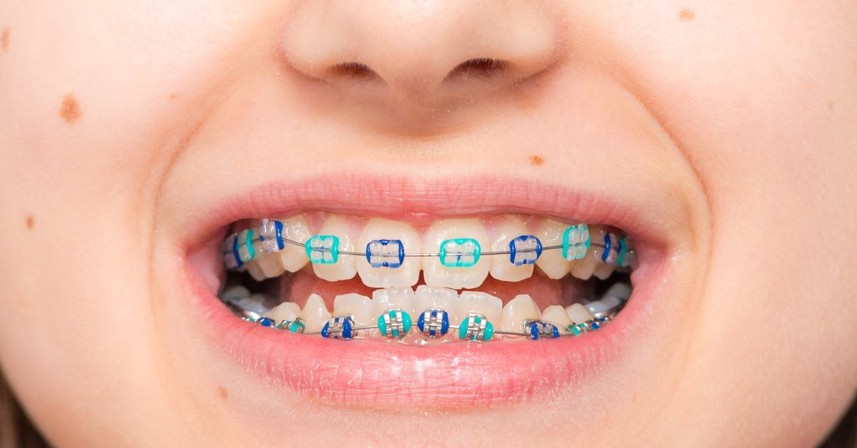 Oral Hygiene Tips for kids with braces